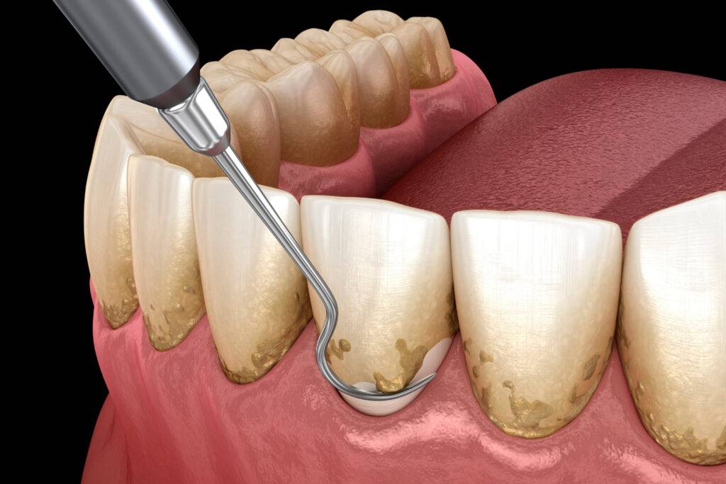 La sonrisa es una carta de presentación que puede abrir puertas y transmitir confianza. Sin embargo, en ocasiones, la pérdida de dientes puede desencadenar una serie de complicaciones que van más allá de la estética. La periodoncia, una rama especializada de la odontología, juega un papel fundamental en el cuidado de las encías y la prevención de la pérdida dental. En este artículo, exploraremos la relación entre la periodoncia y la pérdida de dientes, así como la importancia de mantener una salud bucal adecuada.