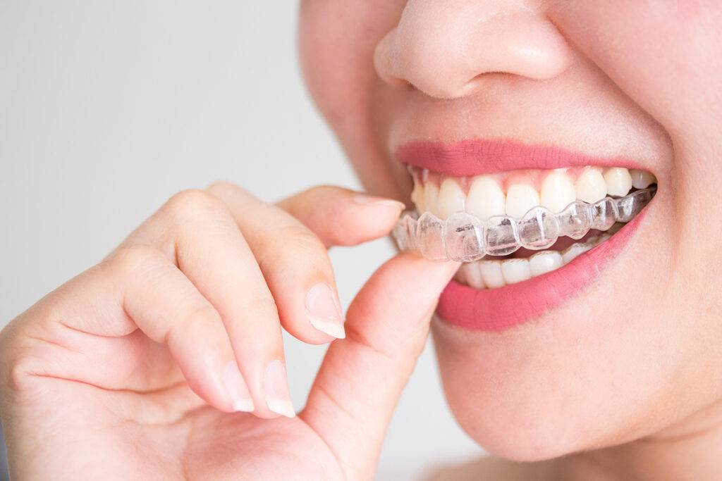 La idea de llevar brackets suele asociarse más con adolescentes. Sin embargo, cada vez más adultos optan por corregir la alineación de sus dientes utilizando esta herramienta. Los avances en tecnología dental han transformado la forma en que vemos los brackets, haciéndolos más discretos y cómodos para personas de todas las edades. Si estás considerando la posibilidad de mejorar la alineación de tus dientes como adulto, aquí te presentamos una guía definitiva que te ayudará a comprender mejor el proceso y a mantener tu estilo mientras llevas brackets.